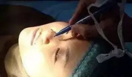隆鼻视频全过程,隆鼻手术全过程解析